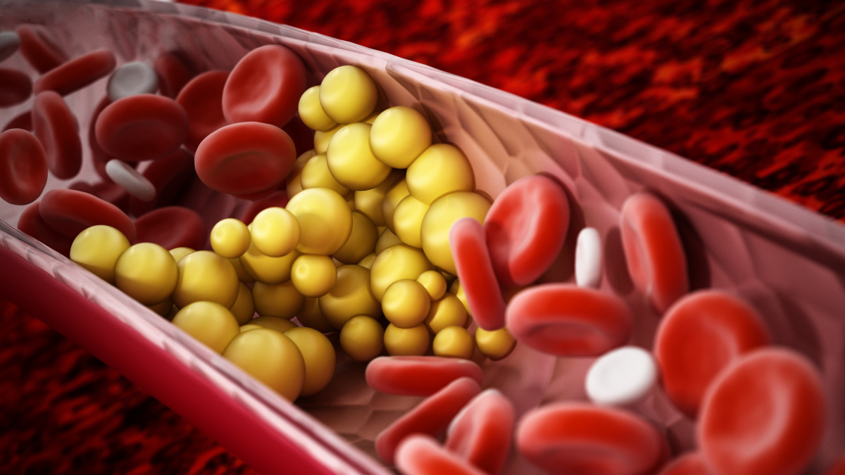 Colesterol malo LDL que obstruye las arterias