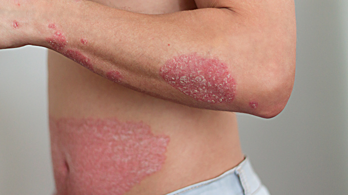 Psoriasis on the arm and stomach